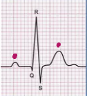 <p>What does QRS stand for?</p>