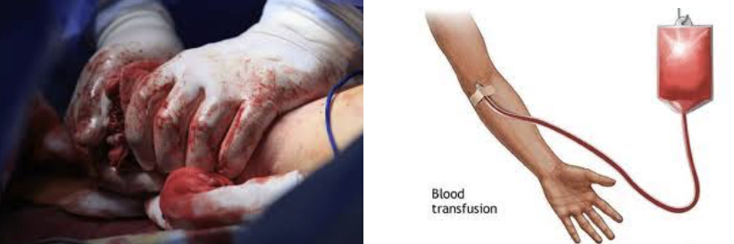 <p><code>Blood loss&nbsp;</code></p><ul><li><p><strong>Acute</strong> <strong>Hemorrhagic Anemia</strong></p><ul><li><p><span style="color: red;"><strong>CAUSE</strong></span> → Blood loss is rapid (as might follow a <span style="color: green;"><strong>severe stab wound</strong></span>)</p></li><li><p><span style="color: blue;"><strong>TREATMENT</strong></span> → Replacing the lost blood</p></li></ul></li><li><p><strong>Chronic</strong> <strong>Hemorrhagic Anemia</strong>&nbsp;</p><ul><li><p><span style="color: red;"><strong>CAUSE</strong></span> → Slight but persistent blood loss (<span style="color: green;"><strong>due to hemorrhoids or an undiagnosed bleeding ulcer</strong></span>)</p></li><li><p><span style="color: blue;"><strong>TREATMENT</strong></span> → Once the primary problem is resolved, normal erythropoietic mechanisms replace the lost blood cells</p></li></ul></li></ul><p></p>