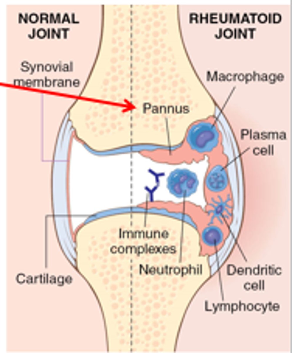 <p>1. arthriogenic antigen exposed to a genetically susceptible host</p><p>2. antigen activates T and B cells</p><p>3. chronic inflammation of synovial tissue (lines the joints) - called a pannus</p><p>4. pannus invades cartilage</p><p>5. bone and cartilage erosion</p>