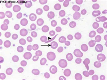 <p>What does this refer to</p><ul><li><p>Target cells, elongated cells, and characteristic sickle erythrocytes</p></li></ul><p></p>