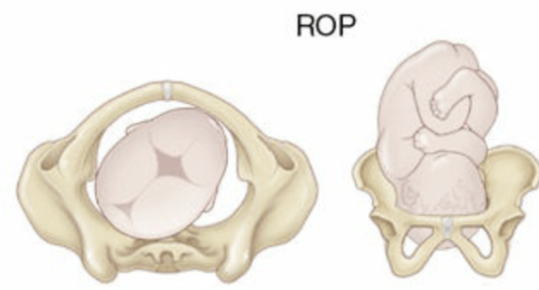 <p>back of the baby’s head is pointing toward the mother’s right back side.</p><ul><li><p>Baby’s Face: the mother’s left front side.</p></li><li><p>leads to back pain and slower labor</p></li><li><p>rotates to anterior position during labor, but may need maternal repositioning to assist.</p></li></ul><p></p>