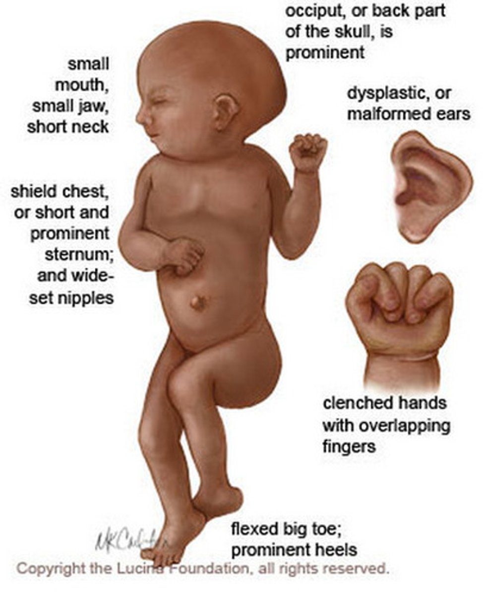 <p>infant born before completing 37 weeks of gestation</p>