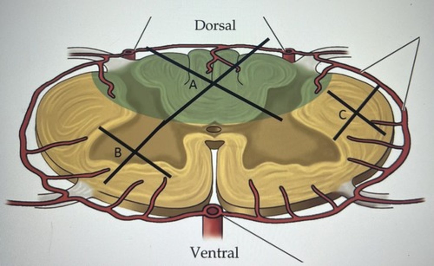 <p>LCT &amp; Rubrospinal tract in lateral column</p><p>no motor control of left limbs at cord level and below</p><p>(tract damage only)</p>