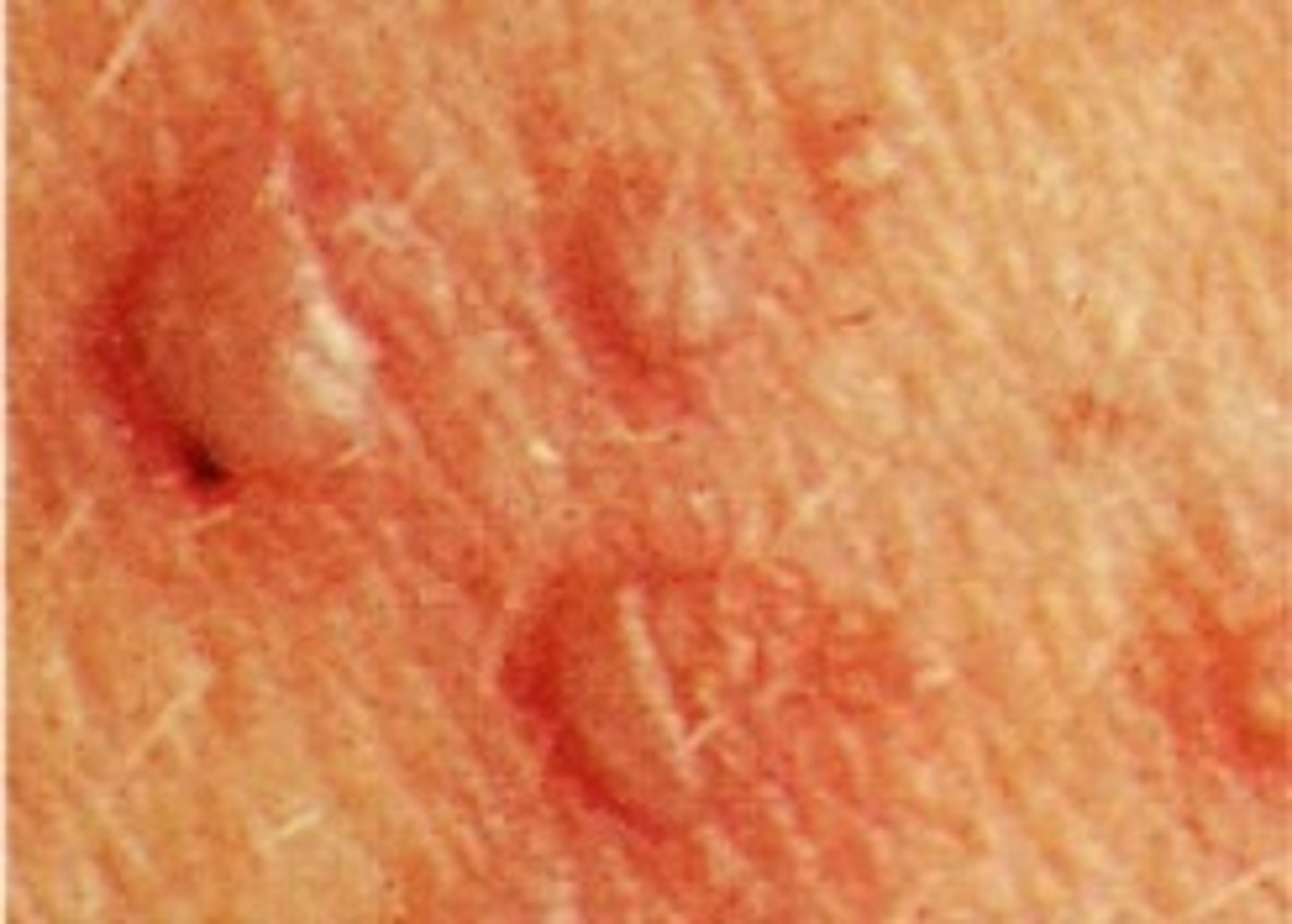 <p>-Epidermal elevation in skin</p><p>-Contains clear fluid (serous)</p><p>-Less than 1/2 cm</p><p>-If bigger than 1/2 cm considered a Bullae</p><p>Examples:</p><p>-Chicken pox</p><p>-Blisters</p>