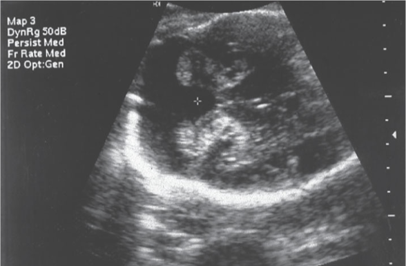 <p>small is associated with Arnold Chiari II</p><p>large is associated with Dandy Walker Malformation </p>