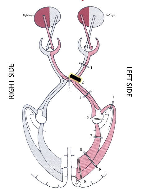 <p>proximal optic nerve lesion</p>