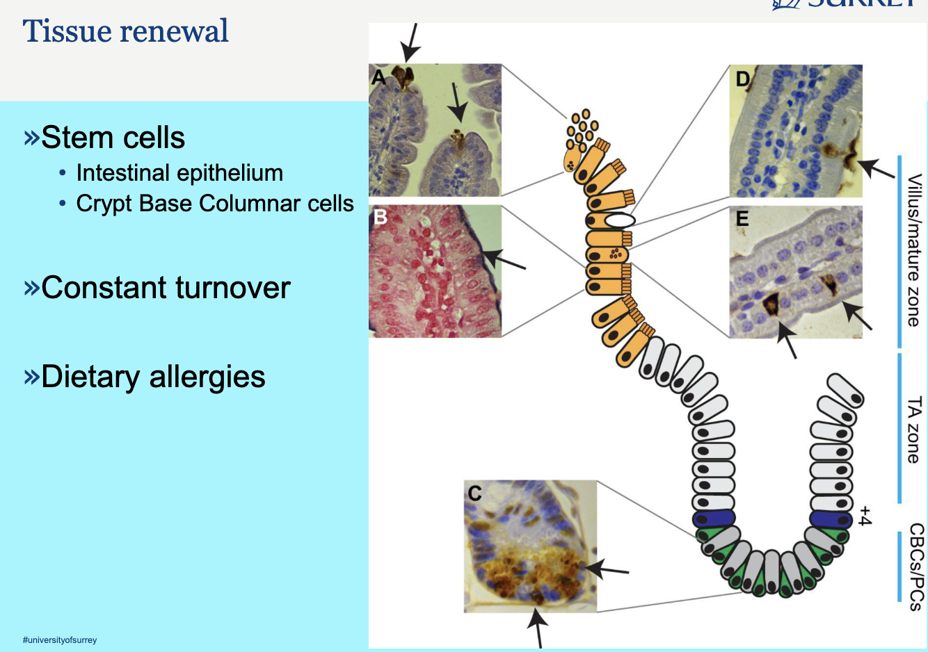 <p>What You Are Looking At: The Intestinal Crypt-Villus Axis</p><p>The diagram illustrates the cellular organization of the lining of the small intestine, which is one of the most rapidly self-renewing tissues in the body. The entire lining is replaced every 4 to 5 days. The structure is divided into two main functional compartments:</p><ol><li><p><strong>The Crypt (The Factory/Stem Cell Niche):</strong> The invaginated, gland-like structure at the bottom, where all new cells are generated.</p></li><li><p><strong>The Villus (The Functional/Differentiated Zone):</strong> The finger-like projection extending upward into the gut lumen, where mature cells perform absorption and are eventually shed.</p></li></ol><p>Explanation of the Notes and Zones</p><p>The notes and zones describe the different cell populations responsible for this constant renewal:</p><p>1. The Stem Cell Niche (The Crypt Base)</p><p>This is the area at the very bottom of the crypt, which houses the true stem cells and their supporting cells.</p><ul><li><p><strong>CBCs (Crypt Base Columnar Cells):</strong></p><ul><li><p><strong>Role:</strong> These are the <strong>Intestinal Stem Cells (ISCs)</strong>. They are the engine of the entire system.</p></li><li><p><strong>Function:</strong> They are responsible for <strong>self-renewal</strong> (making more stem cells) and <strong>multipotency</strong> (generating all the different cell types needed for the intestine).</p></li><li><p><strong>Location:</strong> They are interspersed between the Paneth cells at the very bottom of the crypt.</p></li></ul></li><li><p><strong>PCs (Paneth Cells):</strong></p><ul><li><p><strong>Role:</strong> These are specialized secretory cells that form the <strong>Stem Cell Niche</strong>.</p></li><li><p><strong>Function:</strong> They do <em>not</em> renew the tissue themselves. Instead, they secrete essential signaling molecules (like Wnt ligands) that are critical for maintaining the CBCs in their stem cell state and promoting their proliferation. They are the <strong>support staff</strong> for the stem cells.</p></li><li><p><strong>Location:</strong> They are located at the base of the crypt, intermingled with the CBCs.</p></li></ul></li></ul><p>2. The Proliferative Zone</p><p>This zone is located just above the stem cell niche.</p><ul><li><p><strong>TA Zone (Transit-Amplifying Zone):</strong></p><ul><li><p><strong>Role:</strong> This is the zone of rapid cell division.</p></li><li><p><strong>Function:</strong> Cells generated by the CBCs enter the TA zone. They are called <strong>progenitor cells</strong>. They undergo a limited number of rapid cell divisions (amplification) to quickly generate a large pool of new cells before they stop dividing and begin to differentiate. They are the <strong>production line</strong> of the tissue.</p></li><li><p><strong>Location:</strong> The middle and upper parts of the crypt.</p></li></ul></li></ul><p>3. The Differentiated Zone</p><p>This is the area where cells mature and perform their final function.</p><ul><li><p><strong>The "Other Zone" (The Villus):</strong></p><ul><li><p><strong>Role:</strong> This is the functional surface of the intestine.</p></li><li><p><strong>Function:</strong> Cells that leave the TA zone migrate upward onto the villus. As they migrate, they differentiate into mature cell types (e.g., enterocytes for absorption, goblet cells for mucus secretion).</p></li><li><p><strong>Tissue Renewal:</strong> Once they reach the tip of the villus, they are shed into the gut lumen, completing the renewal cycle.</p></li></ul></li></ul><p>How it Relates to Tissue Renewal</p><p>The entire diagram illustrates a highly organized, unidirectional flow of cells:</p><p><span><span>CBCs (Stem Cells)→Self-Renewal/DifferentiationTA Cells (Proliferation)→Migration/MaturationDifferentiated Cells (Function)→SheddingRenewal</span></span></p><p>This system ensures that the intestinal lining is constantly replaced with fresh, functional cells, which is vital for maintaining the barrier function and nutrient absorption capabilities of the gut.</p>
