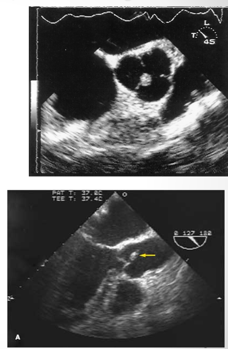 <p>fibroelastoma&nbsp;</p>