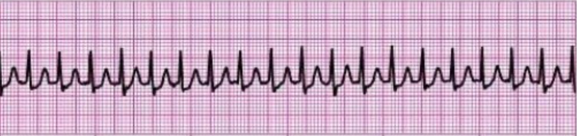 <p>What rhythm does the picture attached depict? </p>