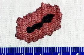 -A blood stain pattern created when a volume of blood has been absorbed by an object