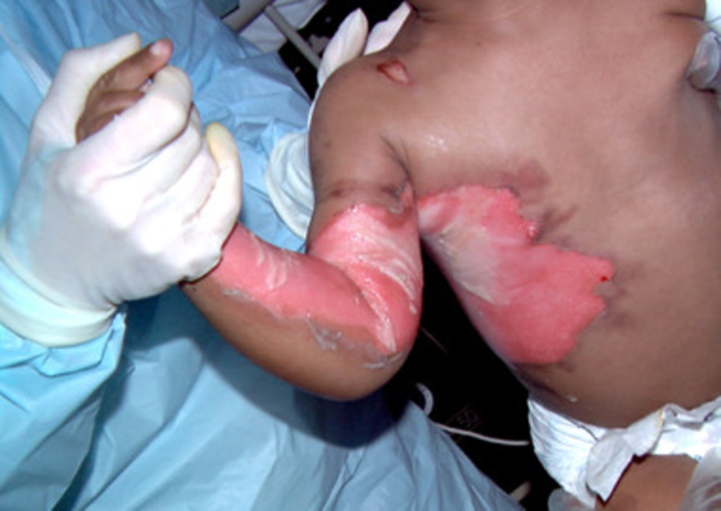 <p>what type of burn is this describing?</p><p>+- blisters; exposed dermis is pale white/yellow</p><p>no cap refill and absent pain sensation (parts more superficial are still painful)</p>