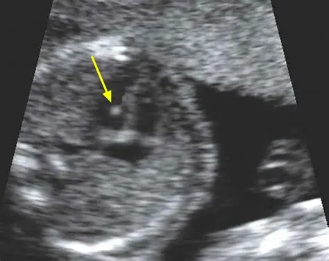 <p>Echogenic Foci (focus) </p>