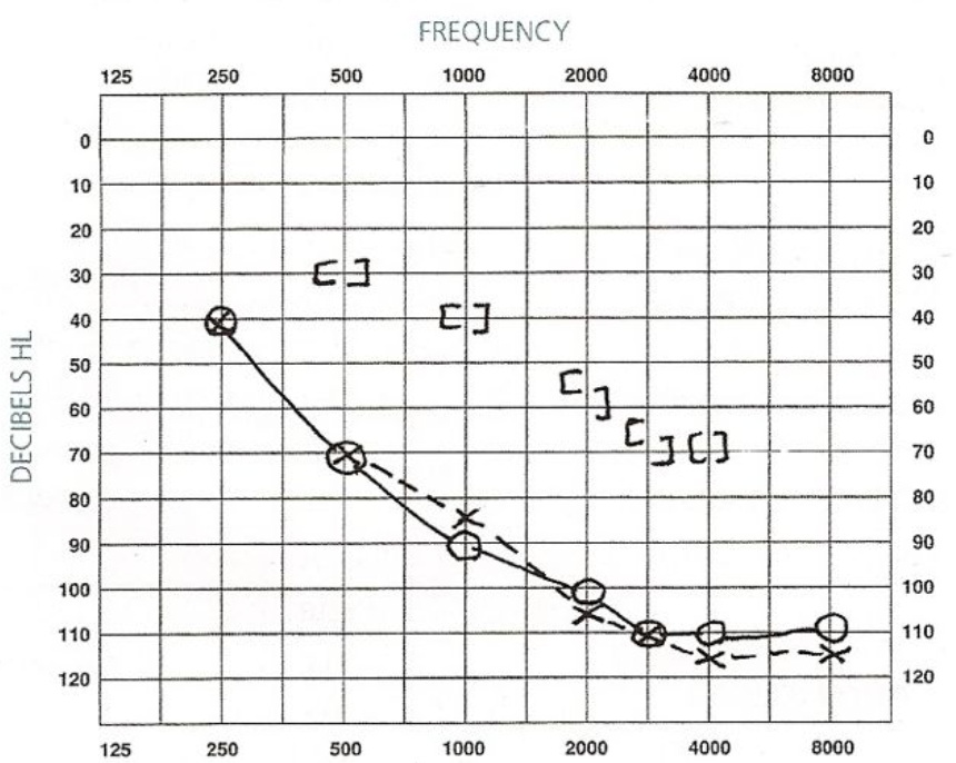 <ul><li><p>air & bone conduction thresholds outside normal limits (elevated) </p></li><li><p>air-bone gap present, but bone conduction also affected </p></li><li><p>(suggests combo of conductive & sensorineural issues) </p></li></ul><p></p>