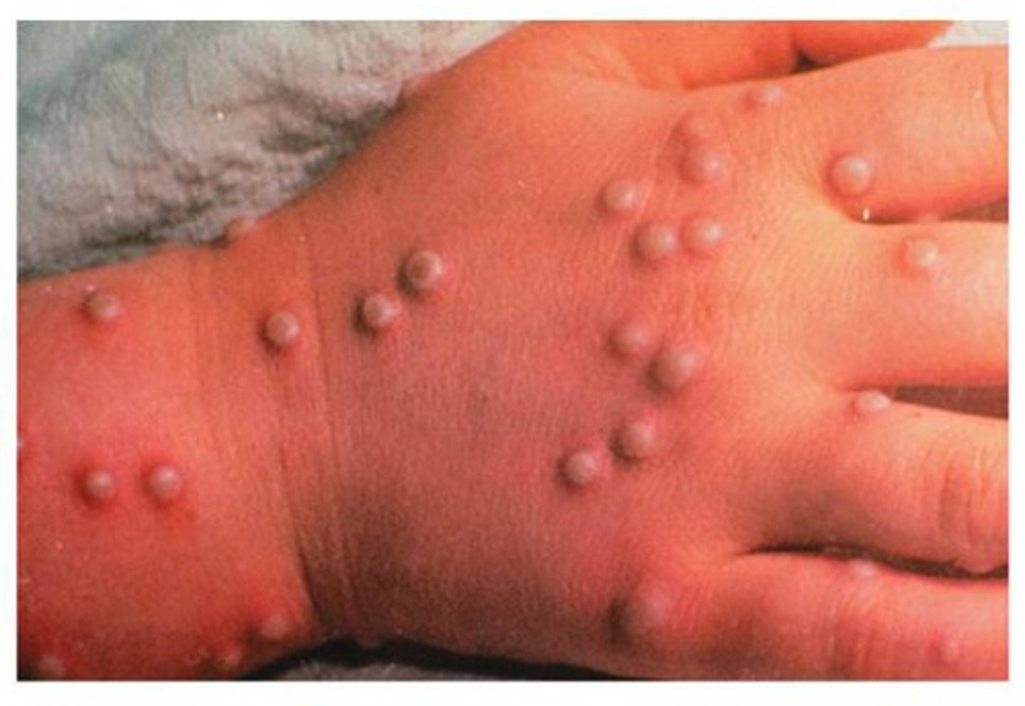<p>High fever, exhaustion, widespread rash that leaves permanent scars (macular --&gt; papules --&gt; vesicles --&gt; crust)</p>