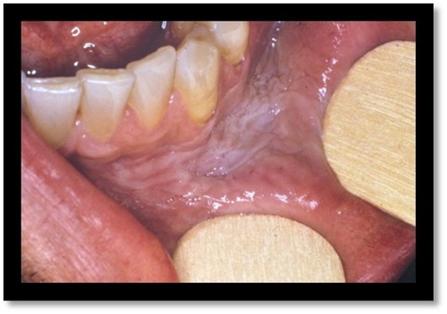 <p>is the development of a white mucosal lesion in the area of tobacco contact</p>