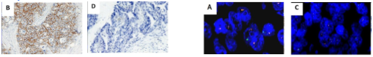 <p><strong>immunohistochemistry </strong>(IHC)<br>• stain performed on tissue → HER2 protein presence<br>• <em>scale:</em> 0, 1+, 2+, 3+<em> → if 3+, no benefit for FISH test</em><br>• less sensitive, highly variable<br>• lower cost<br><em>*positive stain at B</em></p><p><strong>fluorescent in situ hybridization</strong> (FISH)<br>• color changing DNA probes → HER2 <strong>DNA<em> </em></strong><em>within cancer cells<br></em>• ratio of positive probes<br>• more sensitive, less variable<br>• higher cost<br><em>*red &amp; green dots = (+) test at A</em></p>