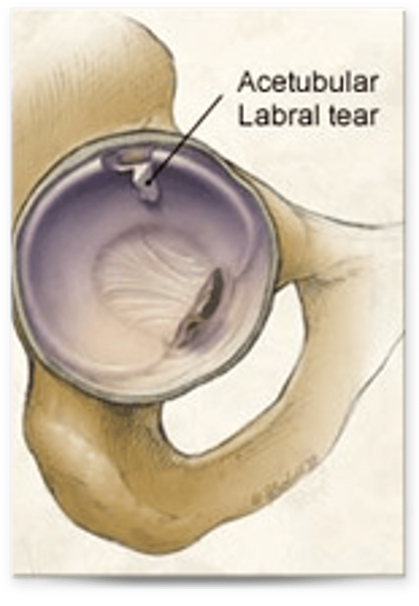<p>Labral tears</p>