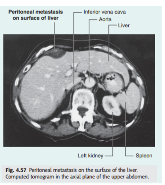 <ul><li><p>Large surface area of peritoneal cavity allows easy abdominal spread of infection &amp; malignant disease</p></li><li><p>If malignant cells enter the cavity via direct invasion (ex. from colon or ovarian cancer), spread can be rapid. Similarly, a surgeon excising a malignant tumor &amp; releasing malignant cells into peritoneal cavity can cause a worsening of the patient’s conditions</p></li><li><p>However, the cavity can also act as a barrier &amp; container for disease — intraabdominal infection tends to remain below the diaphragm rather than spread into other body cavities</p></li></ul>