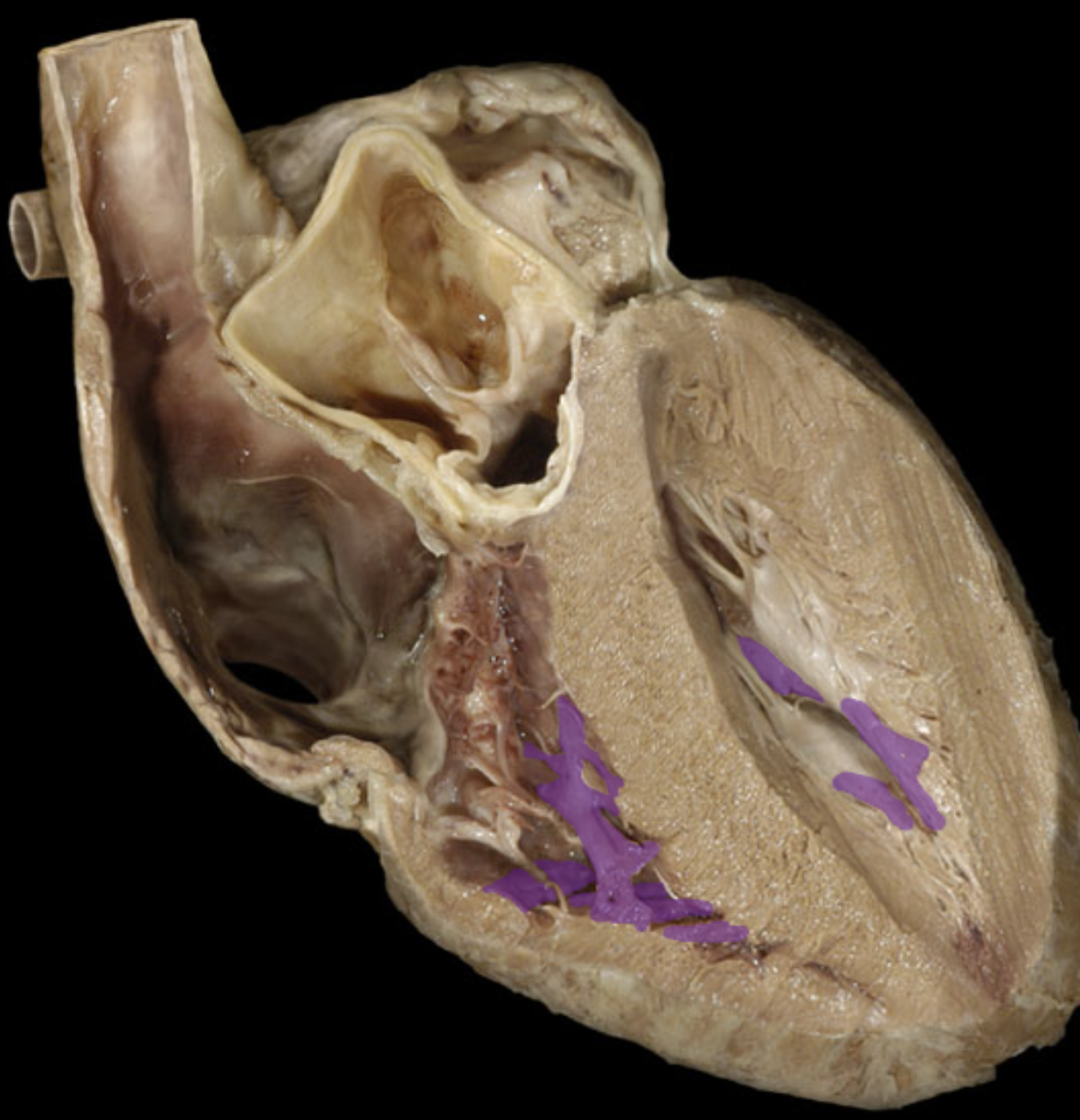 <p>Trabeculae carneae</p>