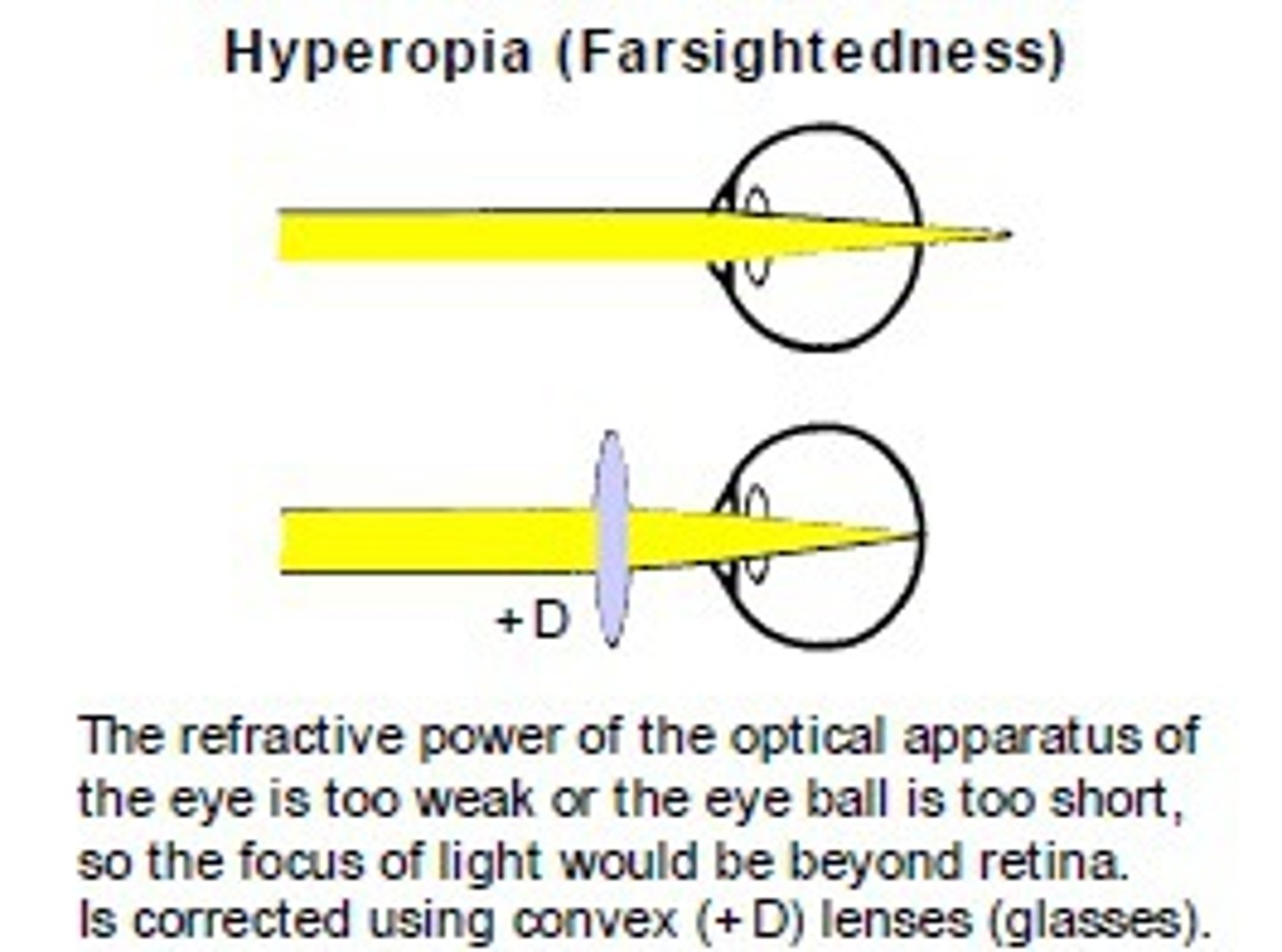 <p>- Eye is too short</p><p>- Rays from near object focuses behind the retina</p>