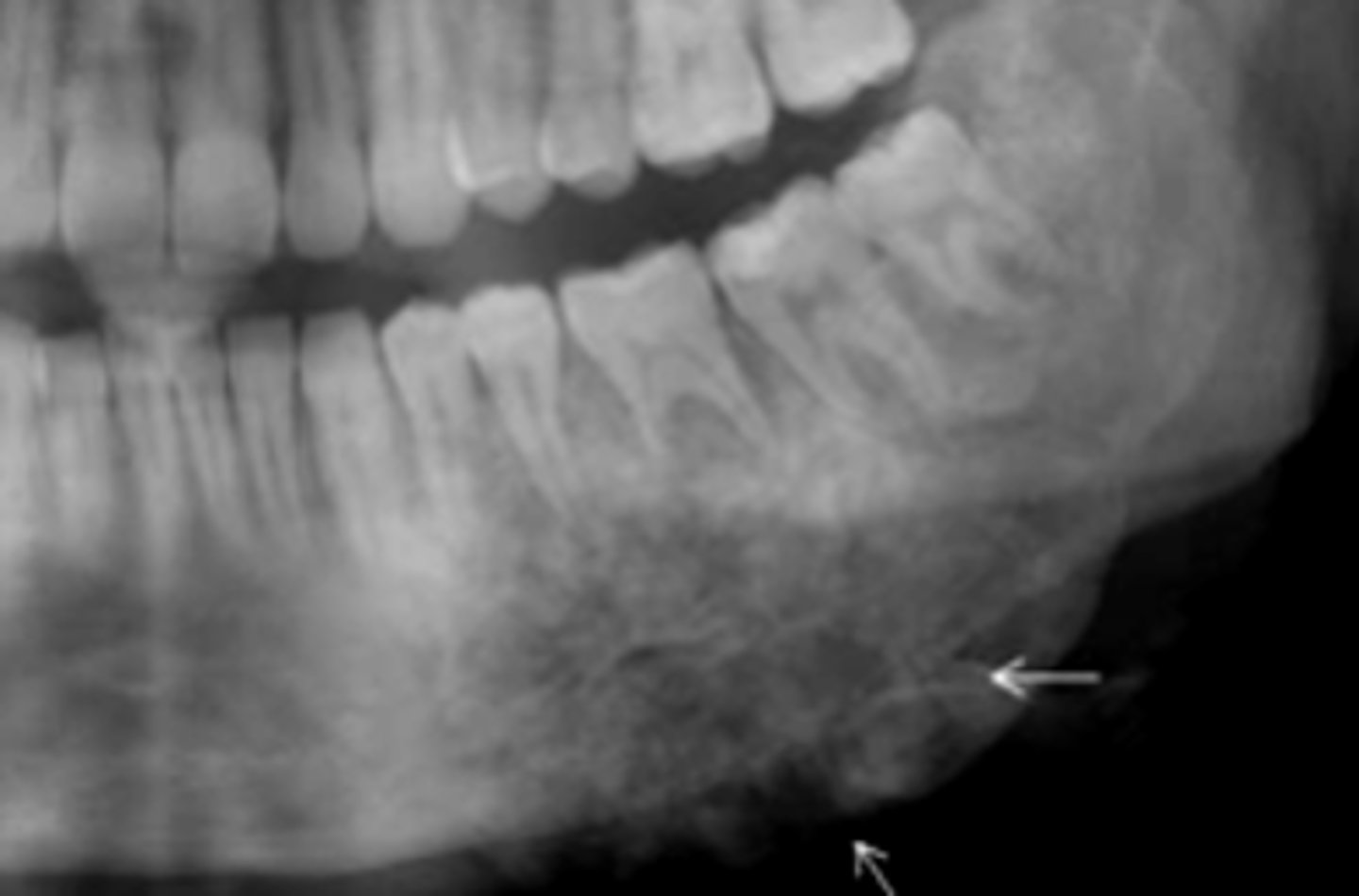 <p>patient's radiograph shows the following:</p><p>•Garrington sign (widened PDL space)</p><p>•Ragged, ill-defined radiolucent/paque mixed area</p><p>•'sun ray' periosteal reaction</p><p>- spiked root resorption pattern</p><p>What is the diagnosis?</p>