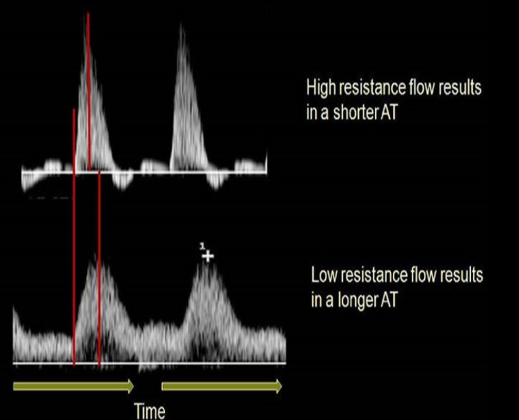 <p>Time from onset of systole to point of maximum systolic peak and is used to differentiate inflow from outflow disease </p>