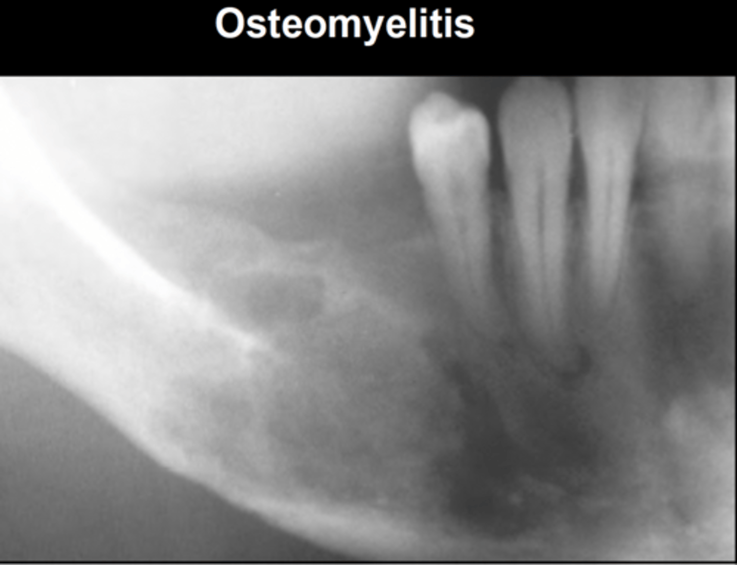 <p>-cannot draw boundaries</p><p>-think malignancy or infection (i.e. osteomyelitis)</p>