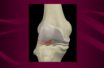 <p>A C-shaped cartilage in the knee that acts as a cushion and stabilizer for the joint, providing support and shock absorption between the femur and tibia. </p>