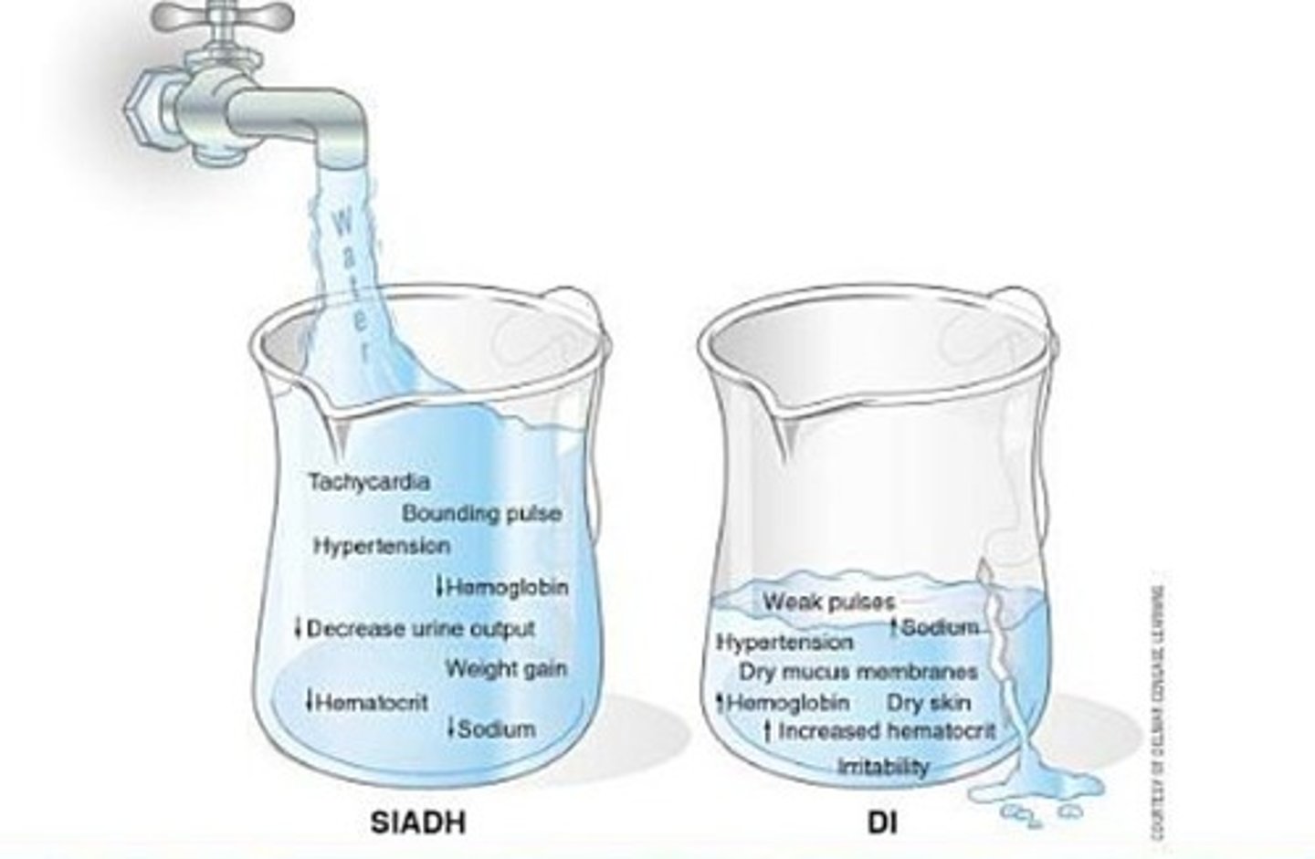 <p>high antidiuretic hormone production leads to <br>water retention<br>increased total body water<br>DILUTIONAL HYPONATREMIA<br><br>-will see signs of fluid volume overload, changes in loc, weight gain w/o edema, hypertension, tachycardia<br>-seizure precautions</p>