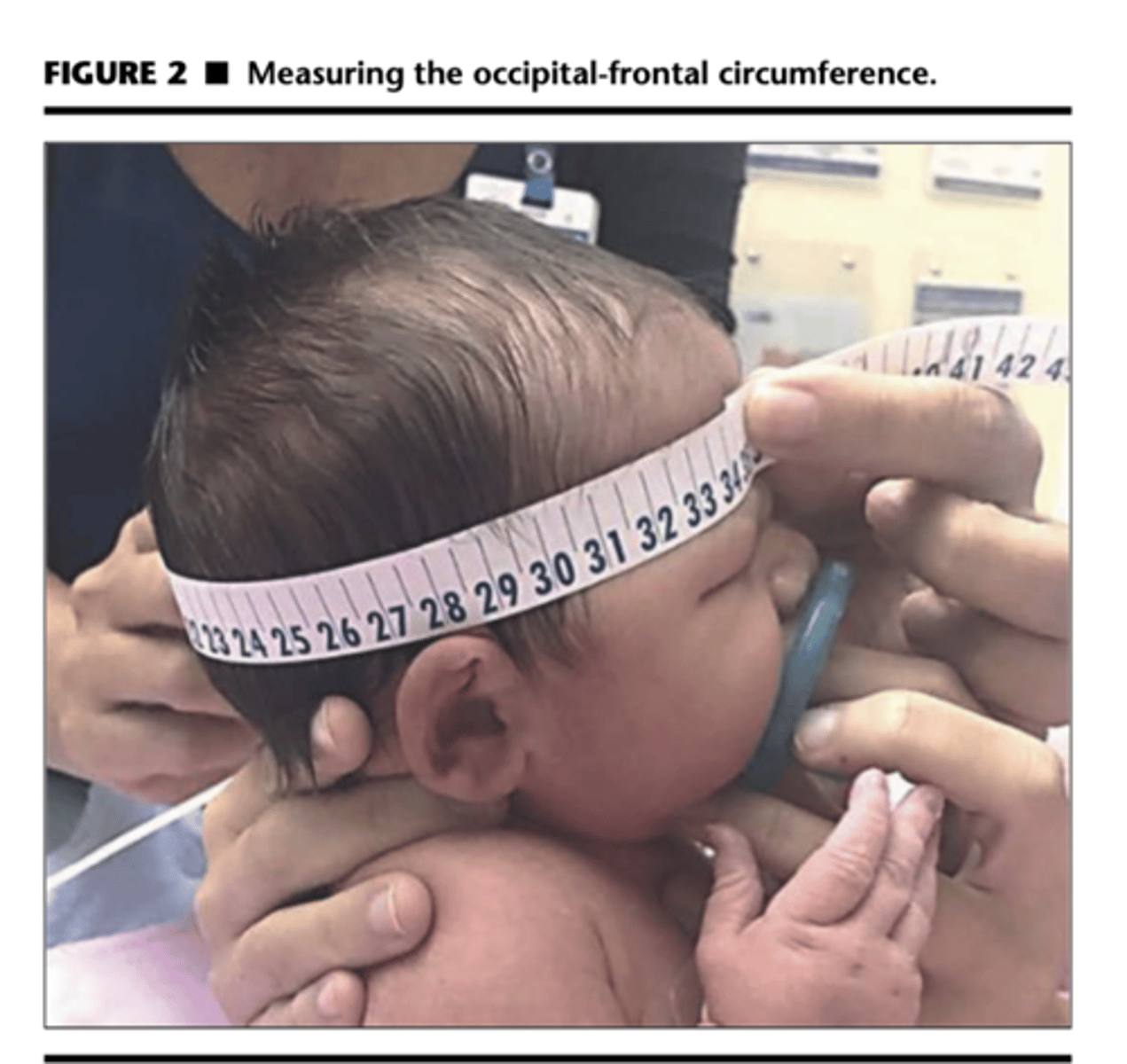 <p>Microcephaly is a head cir- cumference measurement two standard deviations below the mean for age.</p><p>premature infant</p><p>zeka virus</p><p>genetic</p><p>macrocephaly is a head circumference measurement two standard deviations above the mean for age.</p><p>hydrocephalus-sunset eyes see more white of eyes,prominent forhead, bulging fontanelle</p><p>Microcephaly or macrocephaly may indicate the presence of a central nervous system abnormality.</p>