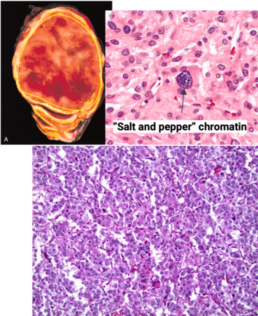 <p>Define Condition:</p><p>Proliferation of chromaffin cells</p><p>-Hx: MC Tumor of Adrenal Medulla in Adults</p><p>-Path: Most FUNCTIONAL (Secrete Catecholamines)</p><p>&gt; A/w mutations</p><p>&gt;&gt; RET (MEN2A &amp; MEN2B)</p><p>&gt;&gt; VHL</p><p>&gt;&gt; NF-1</p><p>**Rule of 10s**</p><p>&gt; 10% = Malignant</p><p>&gt; 10% = Bilateral</p><p>&gt; 10% = OUTSIDE Adrenal Glands (paragangliomas = thorax, abdomen, pelvis)</p><p>&gt; 10% = Children</p><p>-Sx/PE: EPISODIC SX (5Ps)</p><p>&gt; Pressure (More BP)</p><p>&gt; Pain (HA)</p><p>&gt; Perspiration</p><p>&gt; Palpitation/Tachycardia</p><p>&gt; Pallor</p><p>-Dx:</p><p>&gt; Labs:</p><p>&gt;&gt; 24 Hr Urine = </p><p>&gt;&gt;&gt; MORE CATECHOLAMINES (Epi/ME)</p><p>&gt;&gt;&gt; MORE METANEPHRINES (Metabolites) in Urine OR PLAMSA </p><p>&gt; Gross:</p><p>&gt;&gt; Well circumscribed tumor</p><p>&gt;&gt; Size varies from small to large masses</p><p>&gt; Micro:</p><p>&gt;&gt; Polygonal to spindle-shaped cells arranged in nests</p><p>&gt;&gt; Cells have abundant finely granular cytoplasm due to neurosecretory granules containing catecholamines</p><p>&gt;&gt; “Salt and pepper” chromatin - characteristic of neuroendocrine tumors</p><p>&gt;&gt; (+) chromogranin, </p><p>(+) synaptophysin (neuroendocrine markers) immunohistochemistry stains</p><p>-Prog: Depends on METASTASES</p>