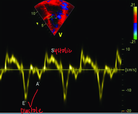 <p>S’ (systolic above baseline) <br>E’ : diastolic below baseline</p><p>A’ : diastolic below baseline </p>