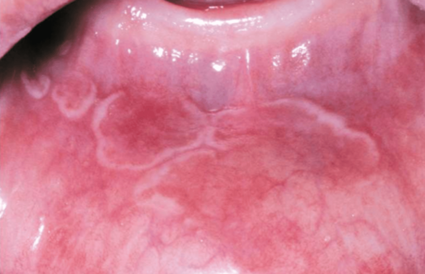 <p>usually asymptomatic, etiology unknown</p><p>abundance of both acute and chronic inflammatory cells</p><p>LESIONS ON MUCOSAL SURFACES --> red, irritated</p><p>lesions develop and then spontaneously regress, then appear again later</p>