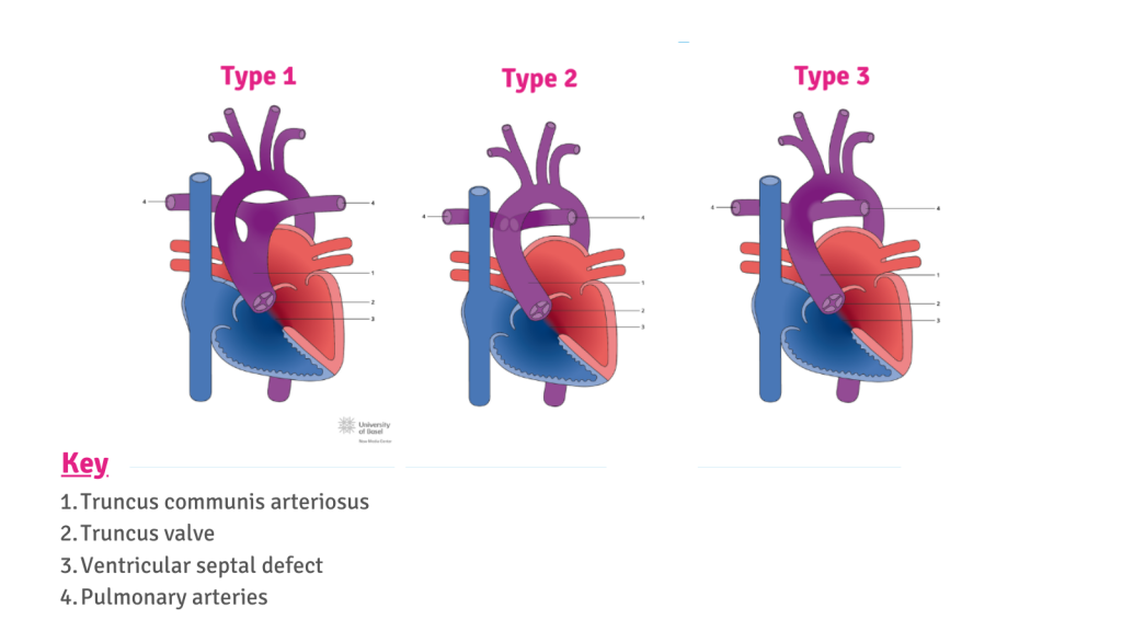 <ul><li><p>rare congenital heart defect where a single blood vessel comes out of the heart, instead of usual two (main pulmonary artery and aorta)</p></li><li><p>symptoms include blue/purple tint to lips, skin, nails (cyanosis); poor eating and poor weight gain; rapid breathing or shortness of breath; profuse sweating, especially with feeding; more sleepiness than normal; unresponsive/ baby seems “out of it”</p></li></ul>