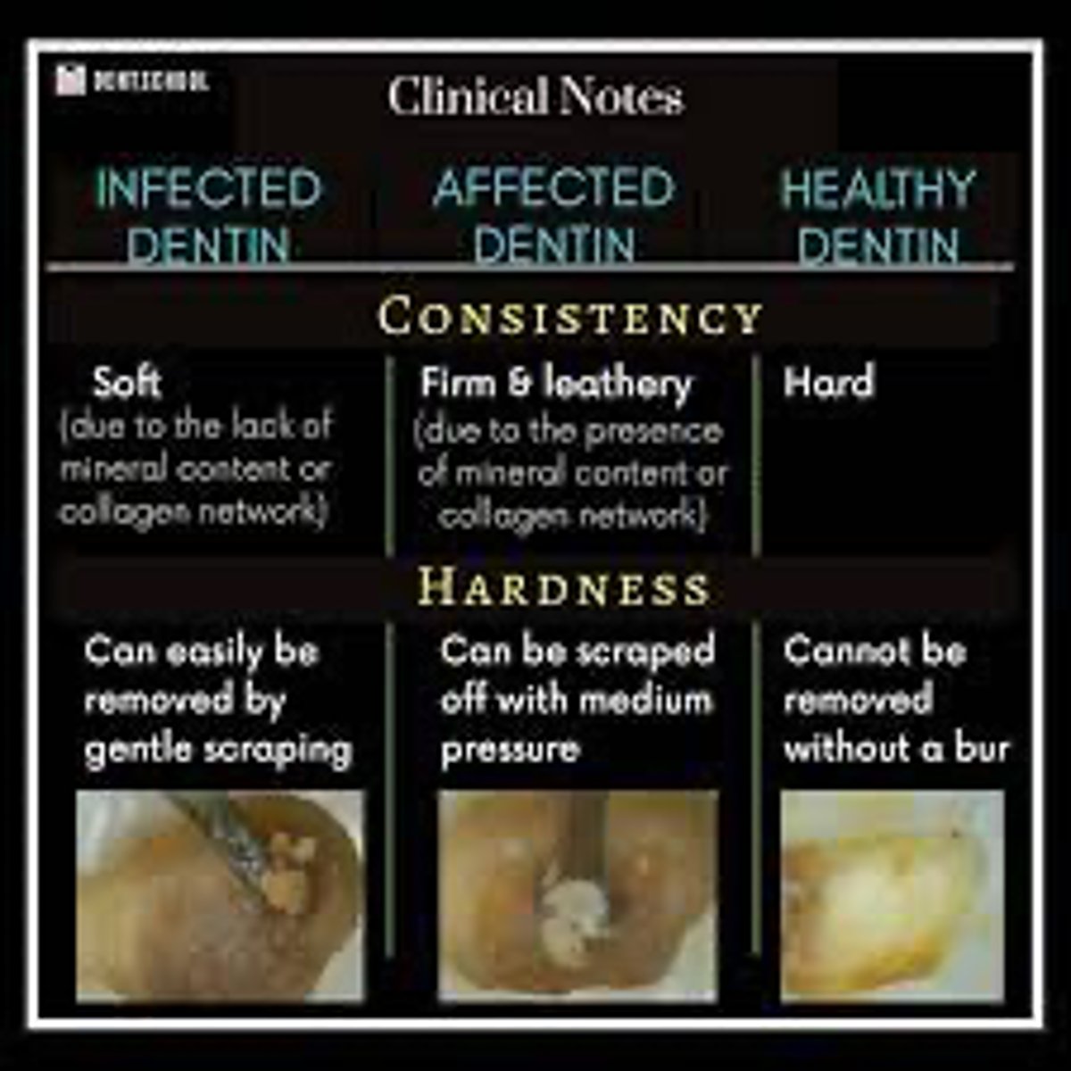 <p>Zones of Dentinal Caries:</p><p>Infected Dentin=</p><p>Affected Dentin=</p><p>Sound Dentin=</p>