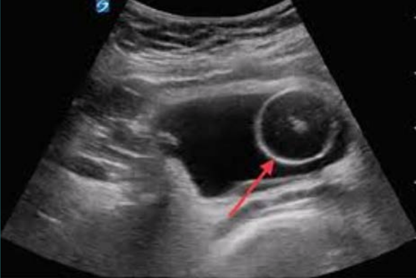 <p>The catheter appears  anechoic, with an echogenic exterior</p>