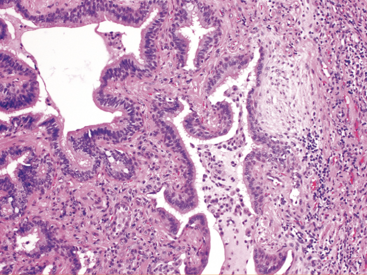<p>Neumonía intersticial usual, ¿qué se encuentra a la izquierda?</p>