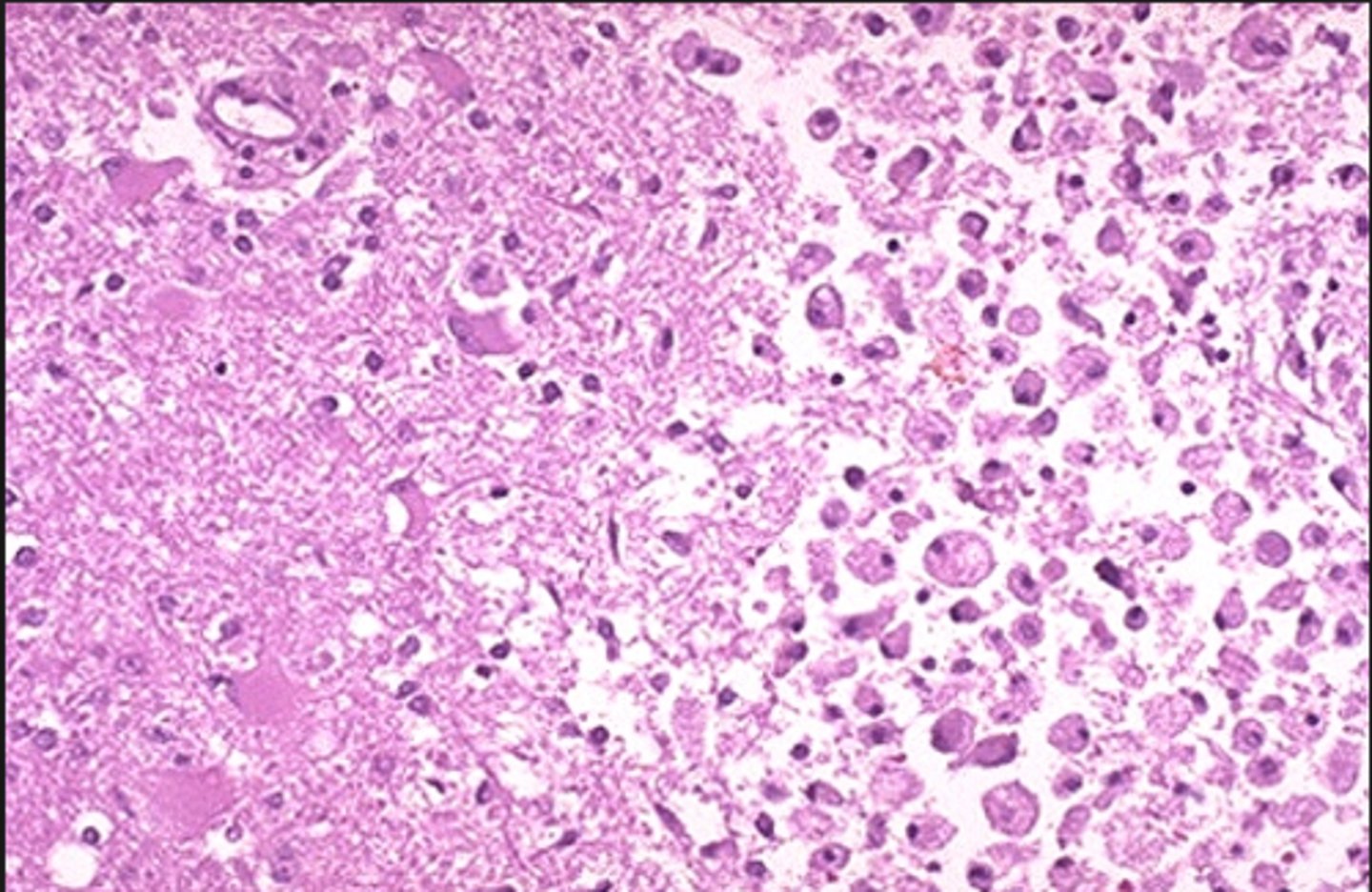<p>"Liquid necrosis", Tissue dissolves, all cell structure is lost.</p>