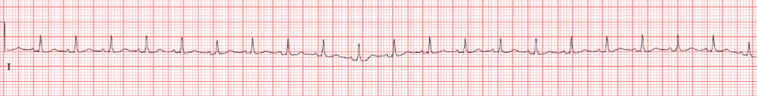 <p>a type of arrhythmia characterized by a heart rate of more than 100 beats per minute, with a regular rhythm and normal P waves arrhythmia</p>