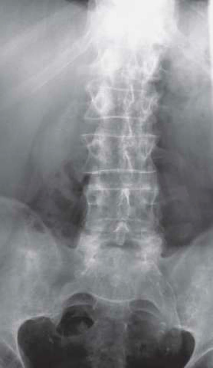 <p>Vignette # 8</p><p>Sex: Female</p><p>Age: 82</p><p>Chief Complaint: Patient presents with sudden onset of low back pain while gardening. Patient reports feeling a sharp pain with movements and feels better with ice. Pain is rated an 8 out of 10 on the pain scale.</p><p>Objective Findings: No orthos were performed due to pain Diagnostic imaging: X-ray</p><p>2. Which tests would be used to diagnose this condition? (Choose 3)</p><p>a. DEXA(for osteoporosis)</p><p>b. MRI</p><p>c. CT</p><p>d. PET</p><p>e. CBC</p><p>f. Angiogram</p><p>g. Abdominal ultrasound</p><p>h. Alkaline phosphatase</p>