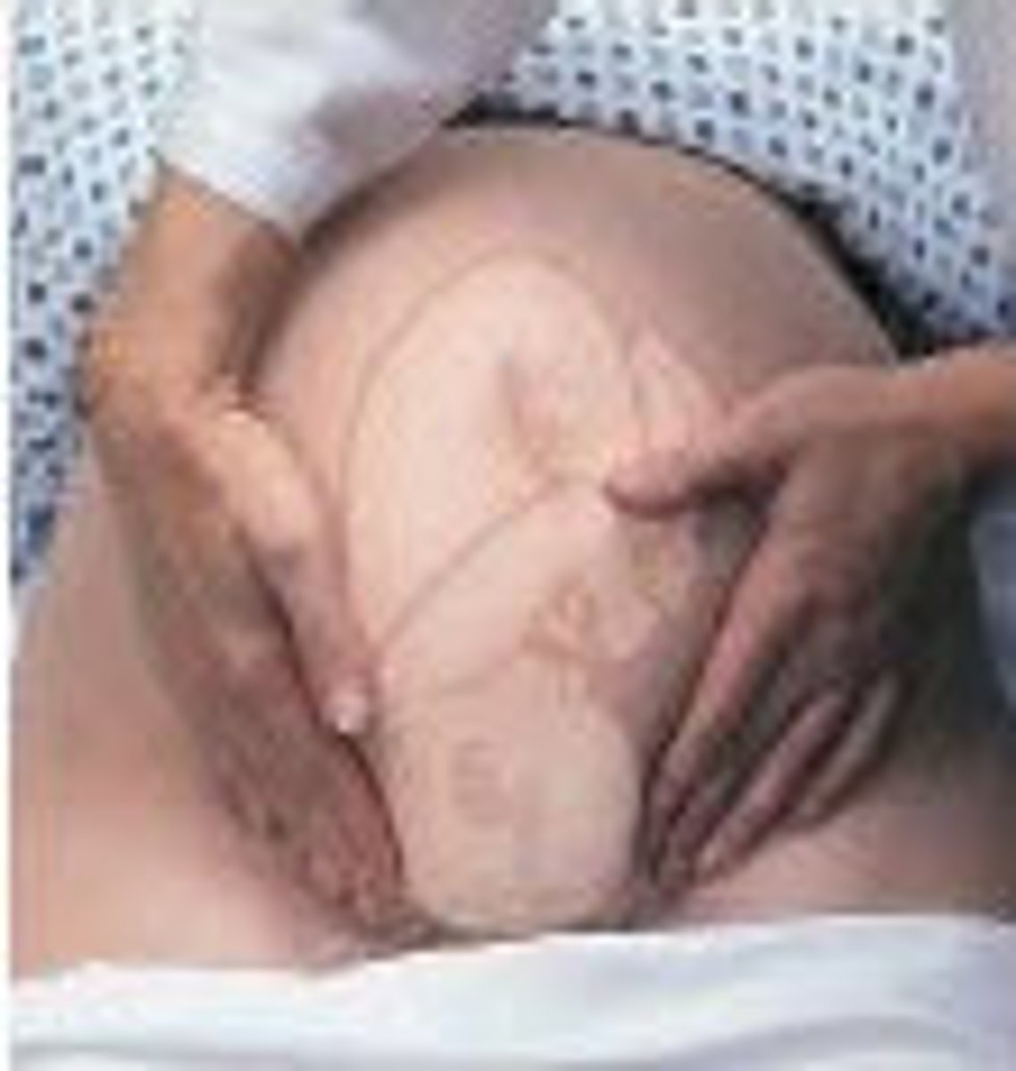 <p>Palpation of bilateral lower quadrants to determine if the presenting part of the fetus is engaged in the mother’s pelvis</p><p>Examiner stands facing the mother’s feet. With the tips of the first 3 fingers of both hands, exert deep pressure in the direction of the axis of the pelvic inlet.</p>