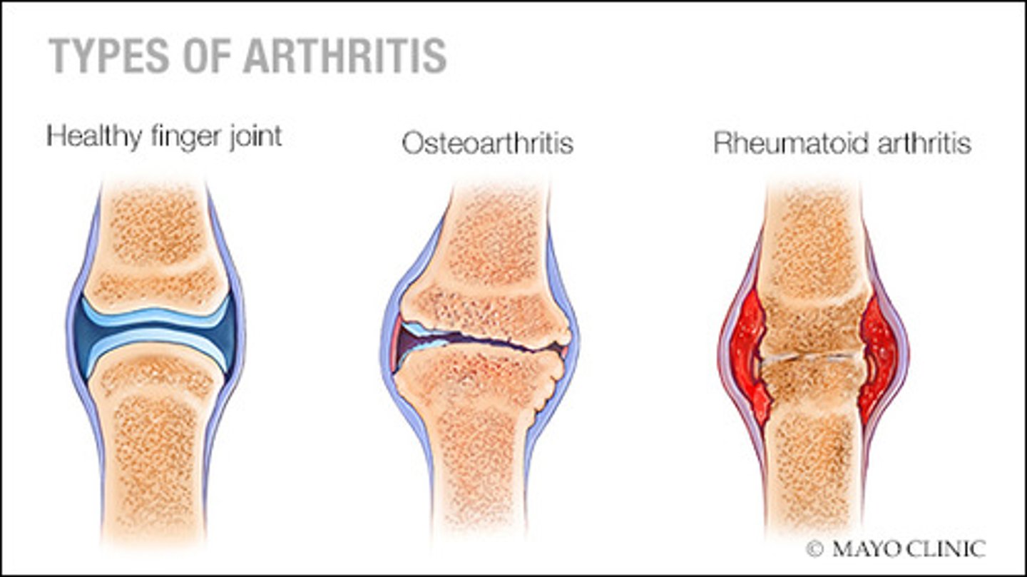 <p>Inflammation of one or more joints, causing pain and stiffness that can worsen with age.</p>