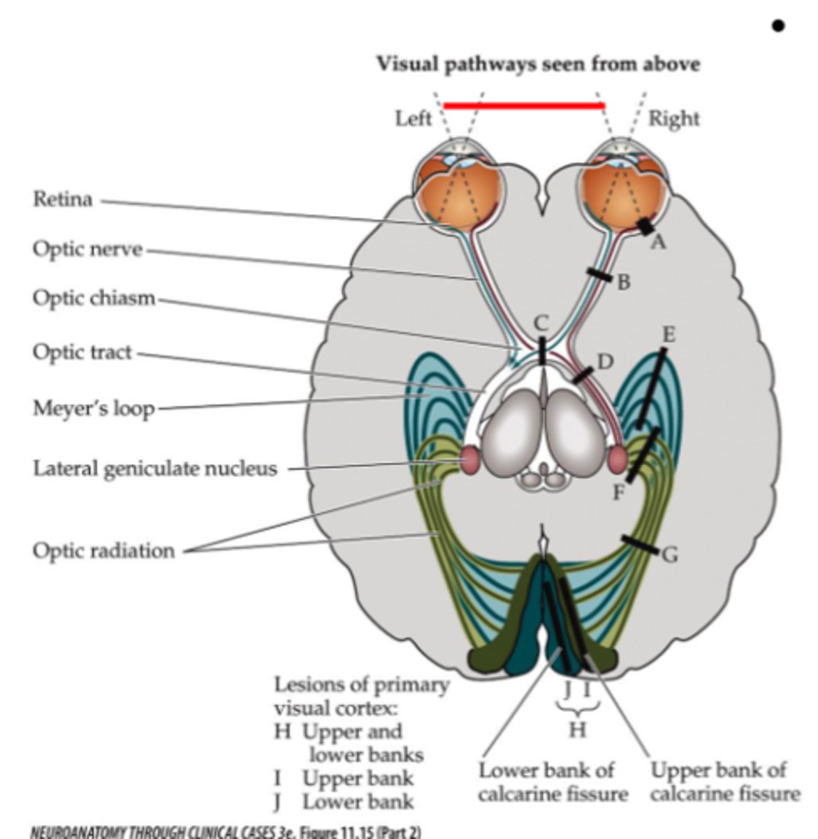 <p>- Right inferior portion of optic radiation</p><p>- Meyer's loop</p>
