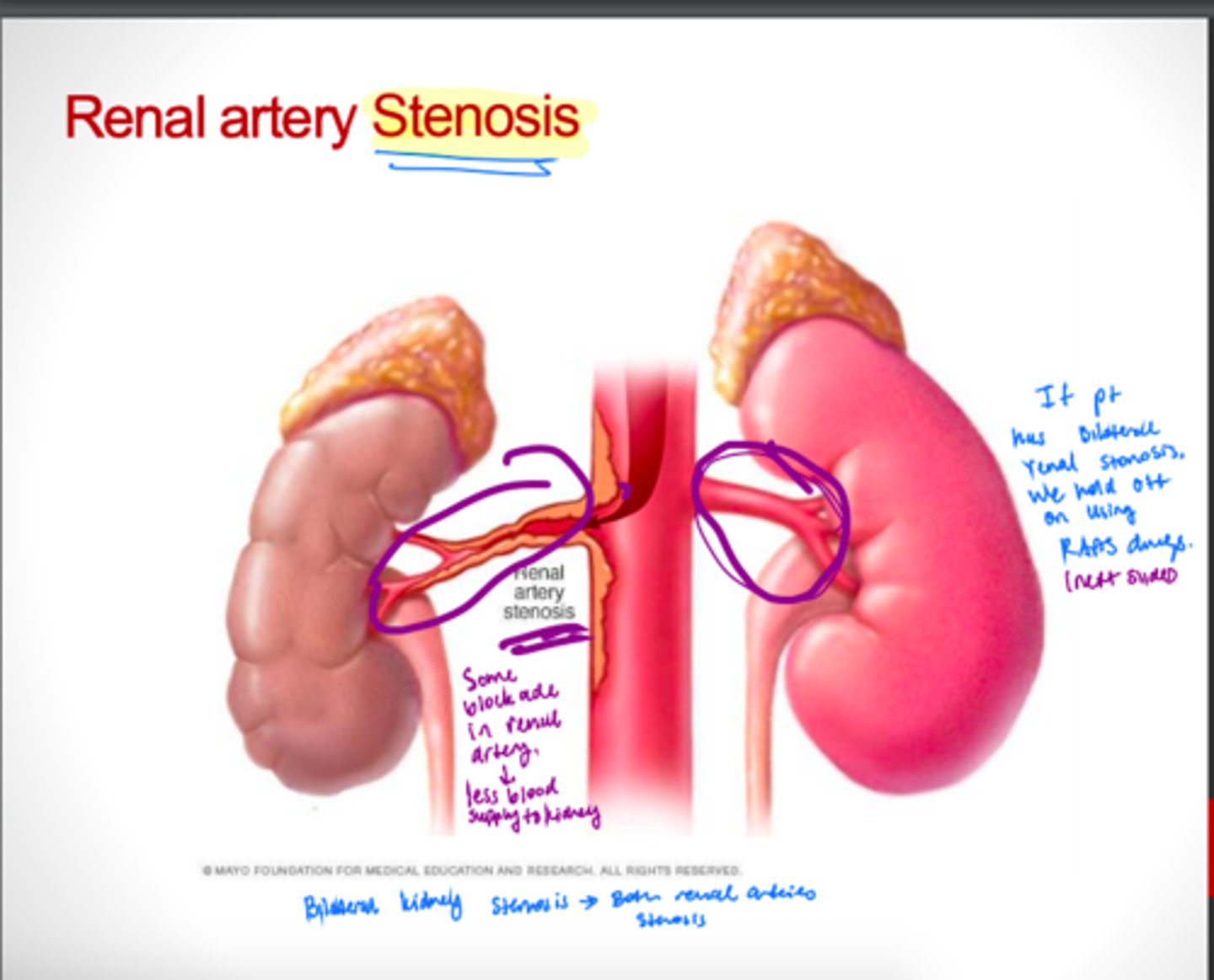 <p>Correctable cause of HTN</p><p>The narrowing of one or more arteries that carry blood to your kidneys</p>