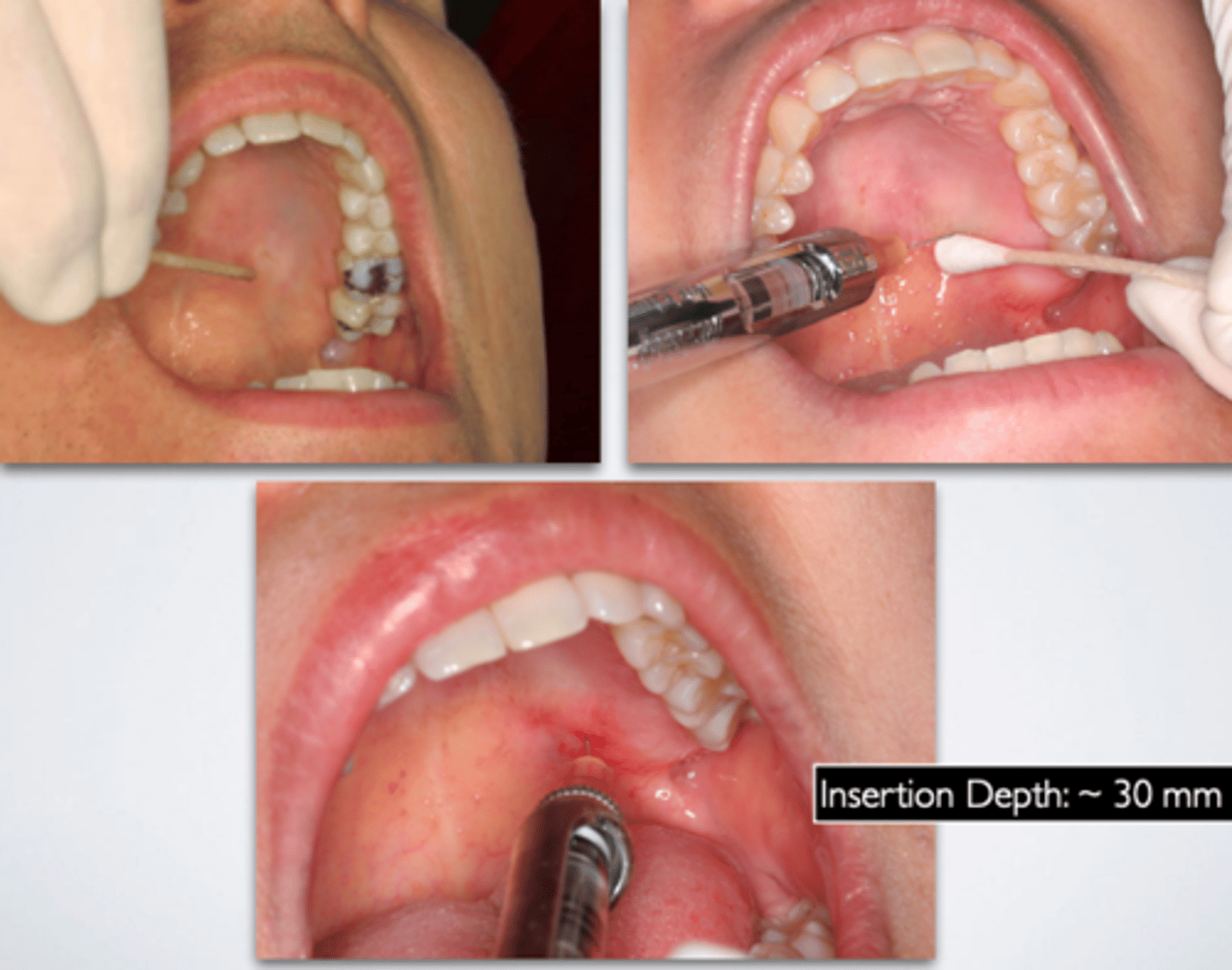 <p>ID the anesthesia technique:</p>