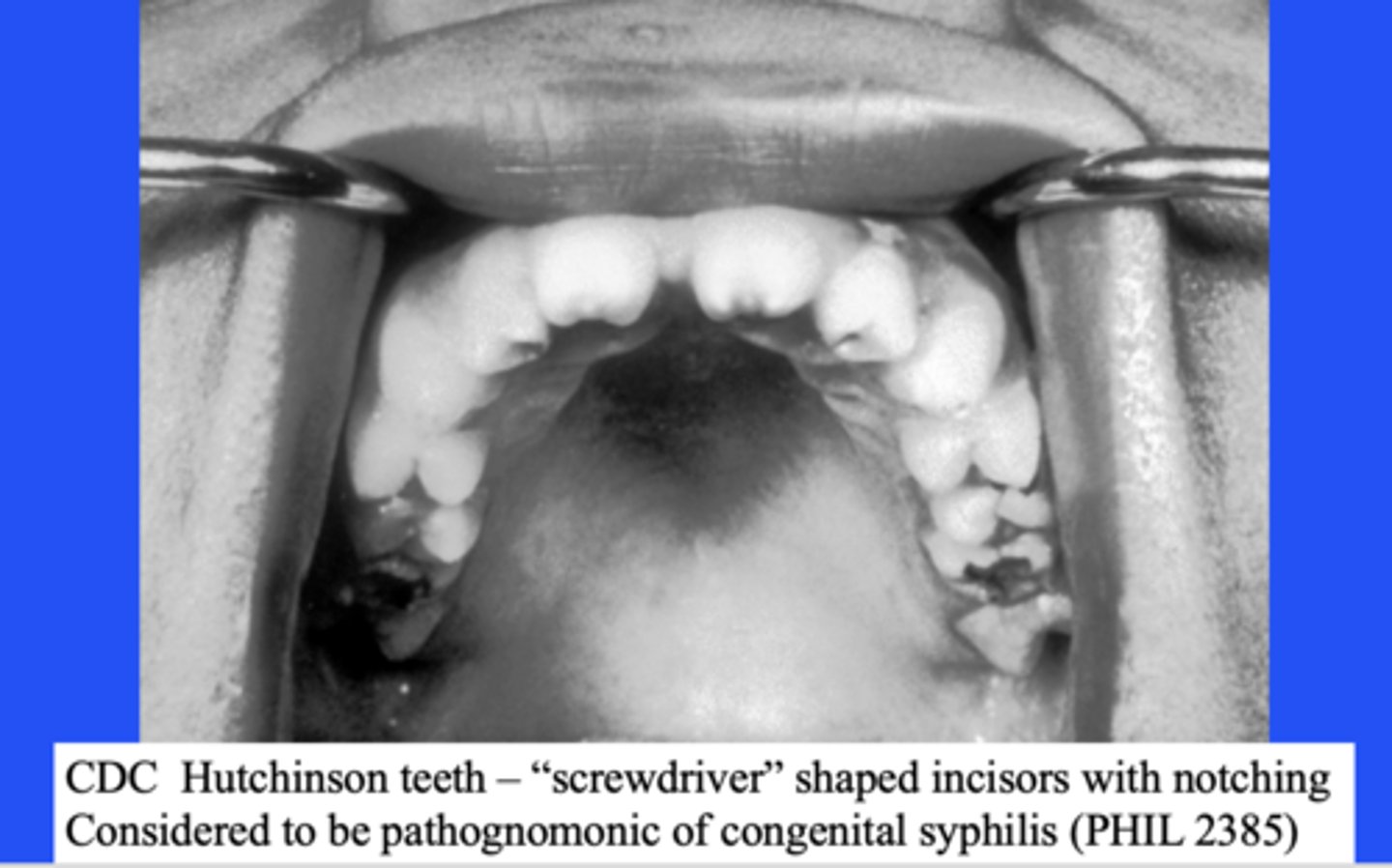 <p>congenital syphilis</p>