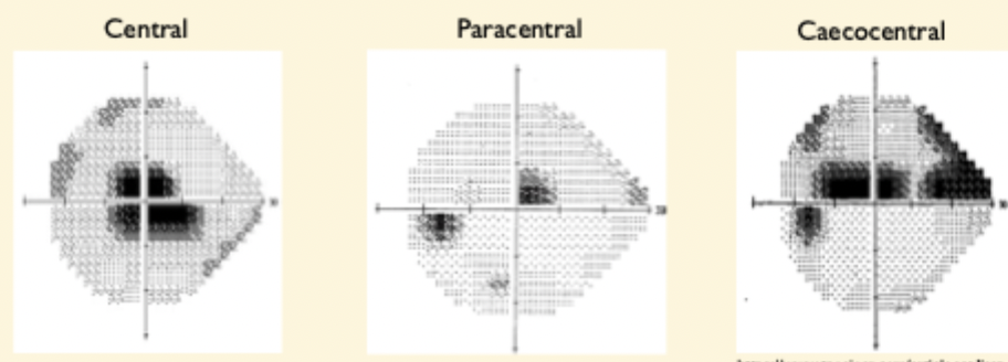 <ul><li><p>localised defect </p></li></ul><p></p><ul><li><p>may be absolute (no vision at all) or <strong>relative</strong> (reduced visual function)</p></li></ul><p></p><ul><li><p>3 types:</p></li><li><p>Central , paracentral and Caecocentral </p></li></ul><p></p>