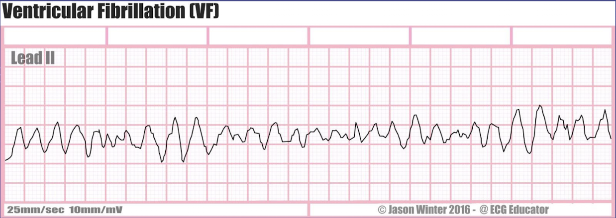 <ol><li><p>rate: cannot reliably identify the heart rate</p></li></ol><ol><li><p>rhythm: irregular</p></li><li><p>P waves: cannot be identified</p></li><li><p>PR interval: cannot be measured</p></li><li><p>QRS interval: cannot be identifed</p></li></ol><p></p>