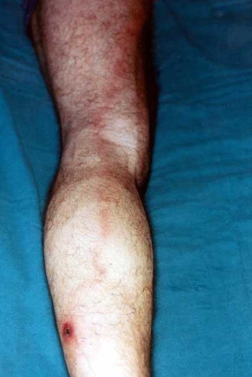 <p>Lymphangitis</p>
