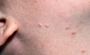 <p><strong>Molluscum Contangiosum: Background and Presentation</strong></p><p>-Etiology → _________ family</p><p>-Epidemiology → most common in childhood, but it can occur in adolescents and adults </p><p>-Symptoms → appear anywhere on the body (except _____/______), but the _____, axilla, antecubital/_______ fossa, crural folds are most common </p><ul><li><p>Firm, ____-______ papules with central ____________</p></li><li><p>Polypoid with stalk like base </p></li><li><p>________</p></li></ul><p></p>